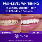Radiant Renewal Teeth Whitening Kit | Nano Optical Brightening Technology | Coffee & Tobacco Stain Eraser