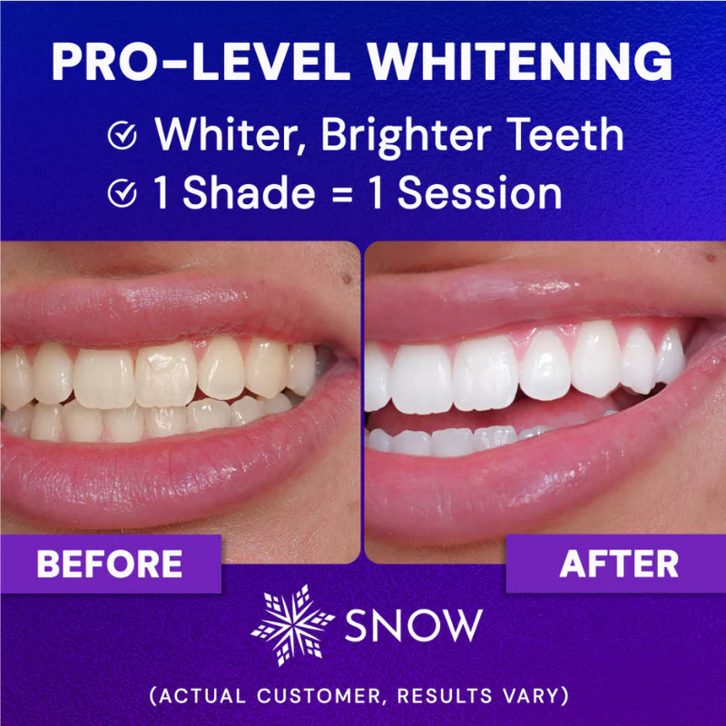 Radiant Renewal Teeth Whitening Kit | Nano Optical Brightening Technology | Coffee & Tobacco Stain Eraser